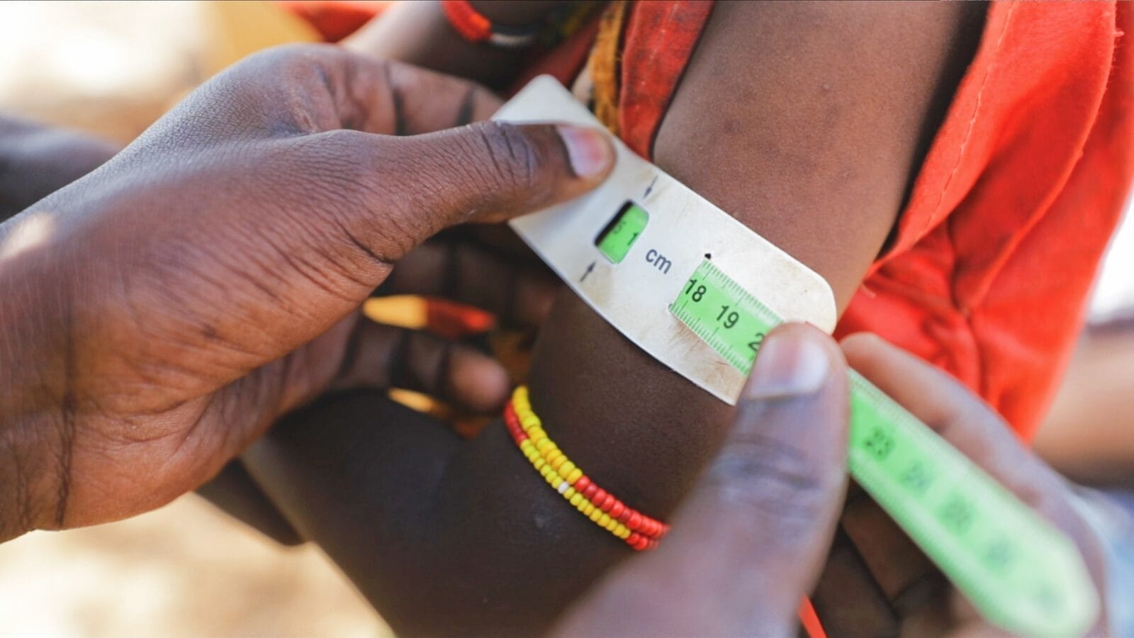 Misurazione del braccio di un bambino malnutrito