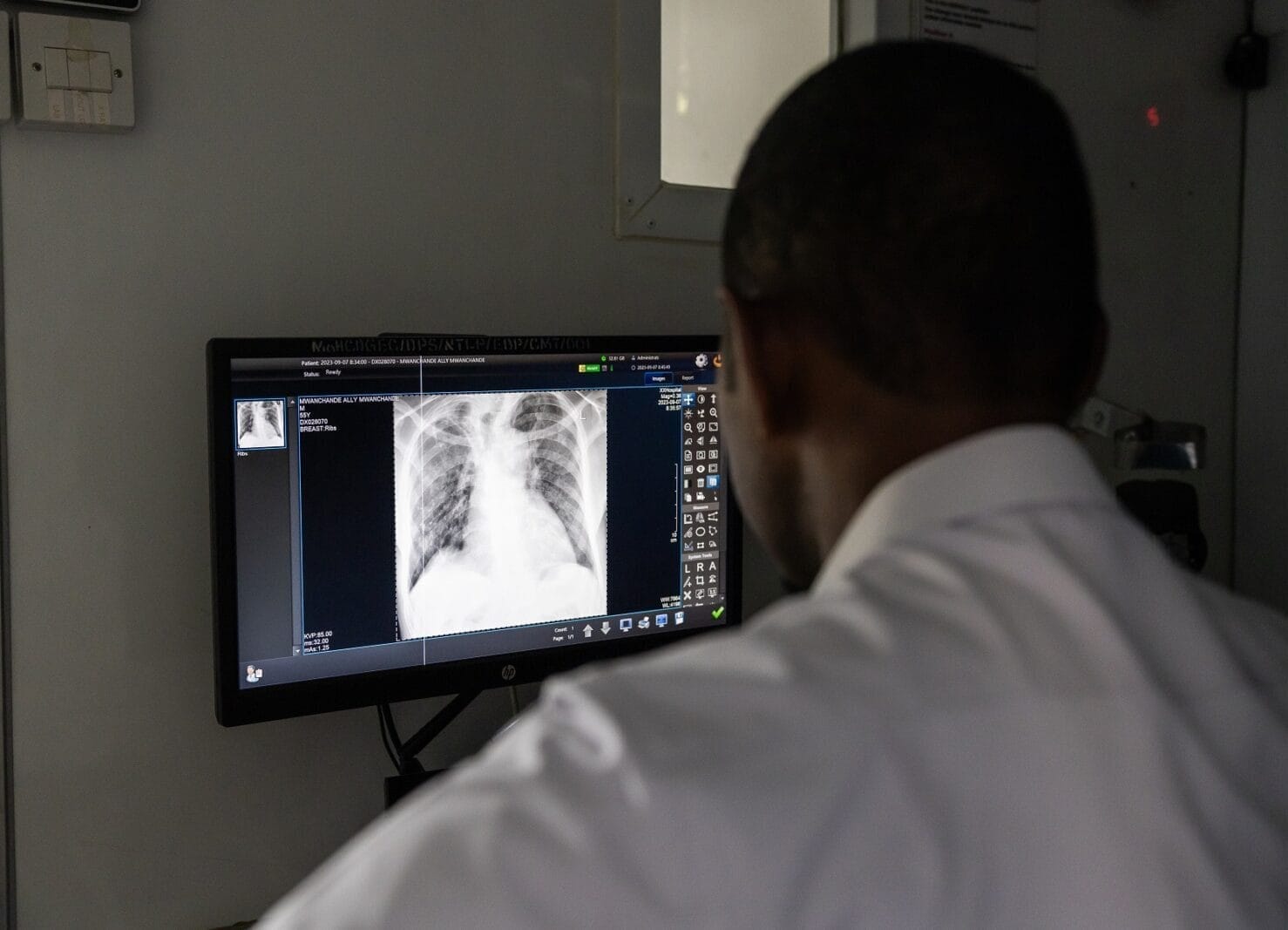 Tubercolosi: impennata di casi